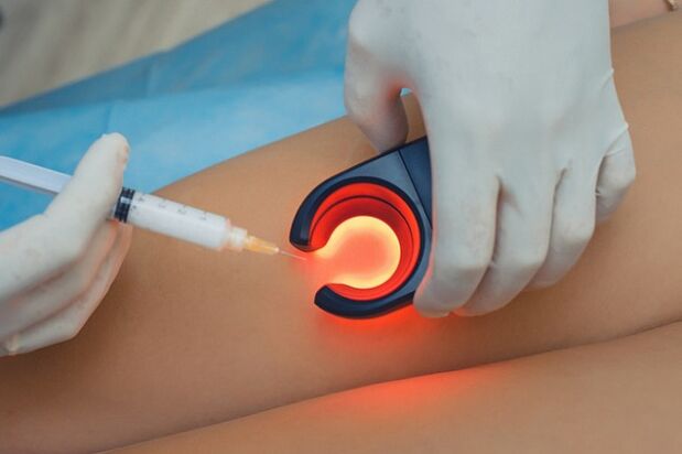 Using sclerotherapy to treat varicose veins