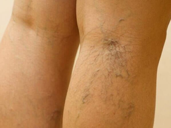 Varicose veins under the knee