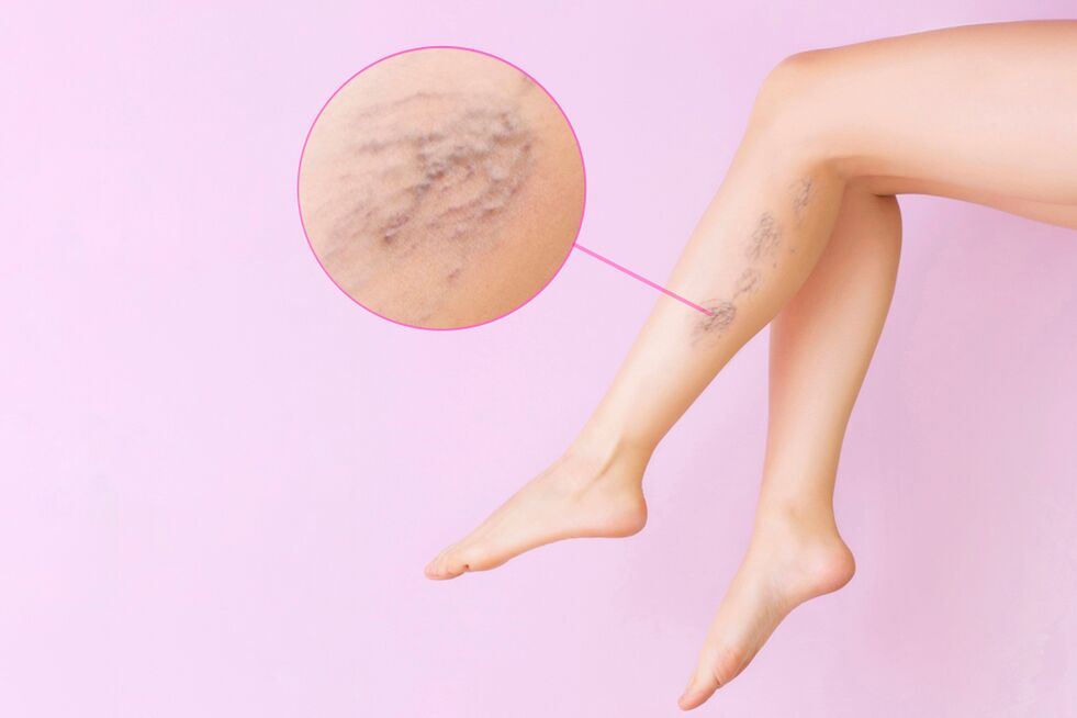 Symptoms of varicose veins in the legs